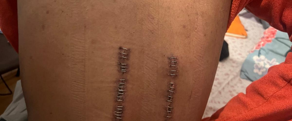 Fundraising for Rankine Mathew by British Malayali Charity Foundation fundraising photo 2